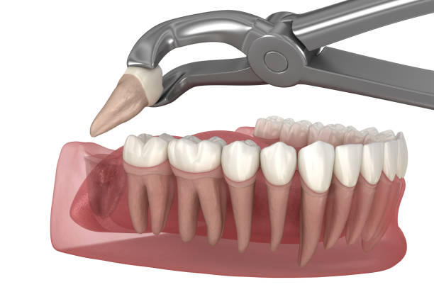 Extractions