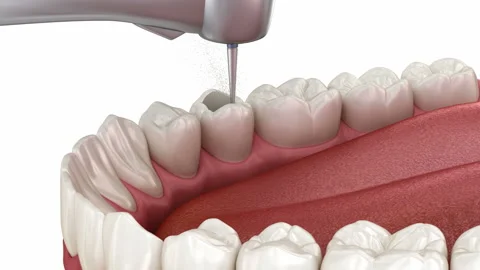 Root Canal